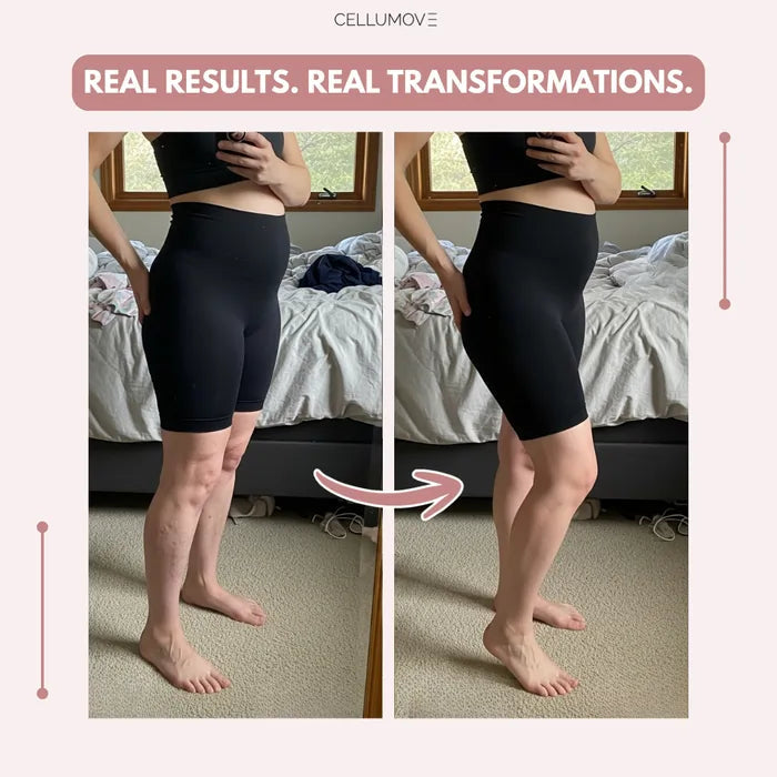 Cellumove 3D Legging – Post partum Edema Cellumove