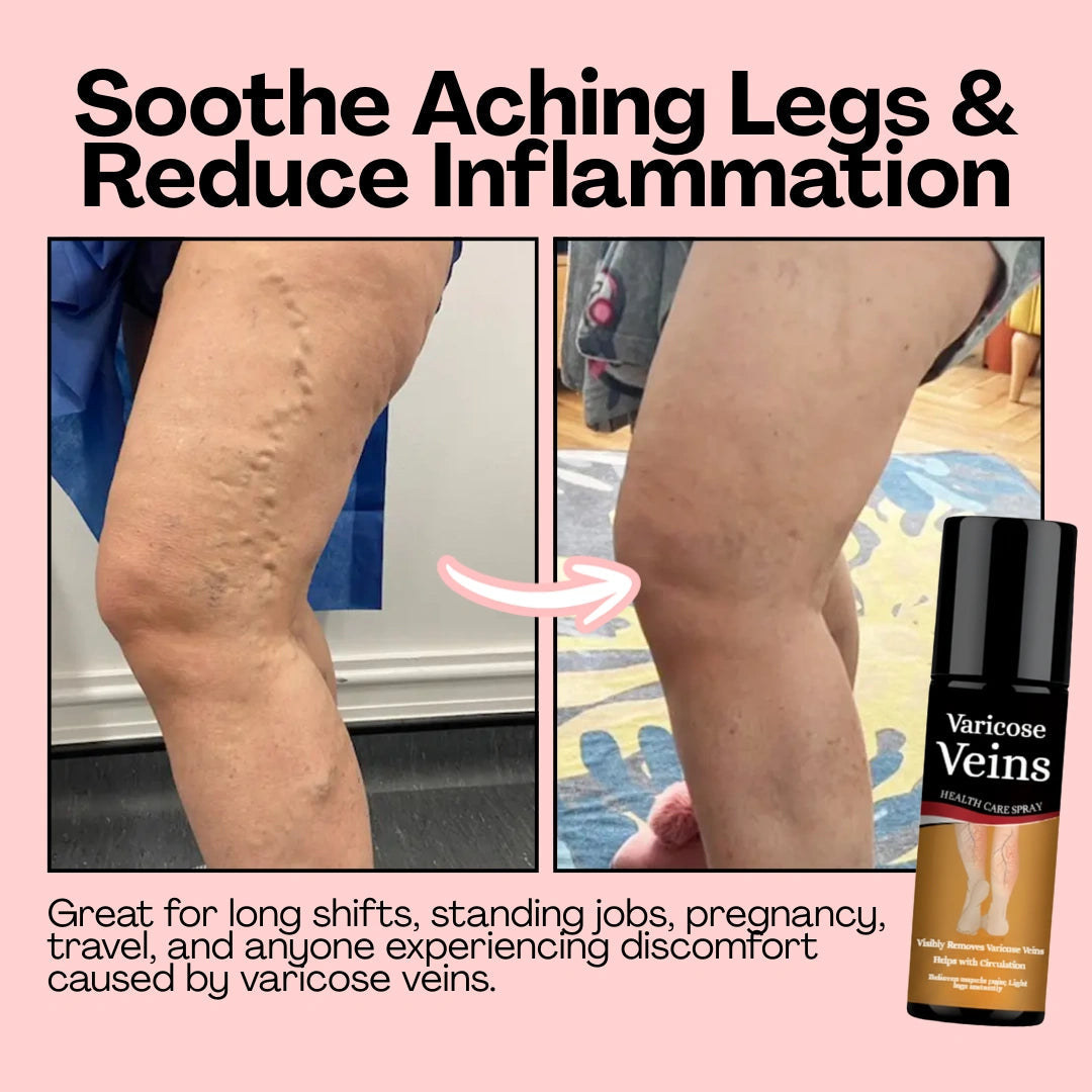 Varicose Vein Spray Leg Pain Gone, Confidence On Cellumove