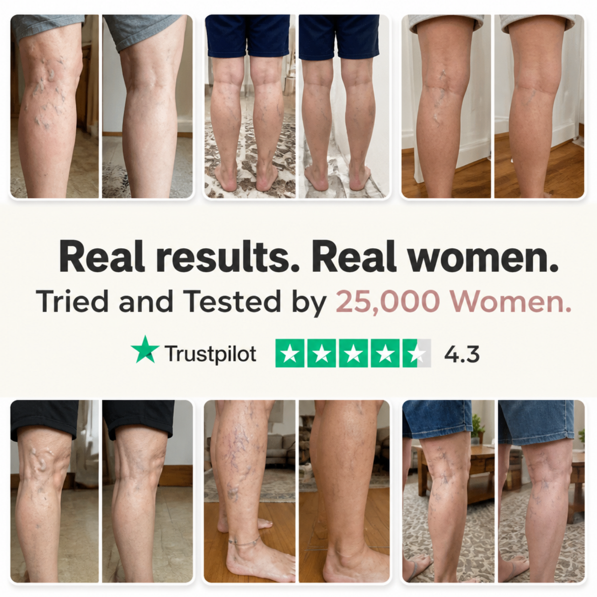 VARICOSE VEINS