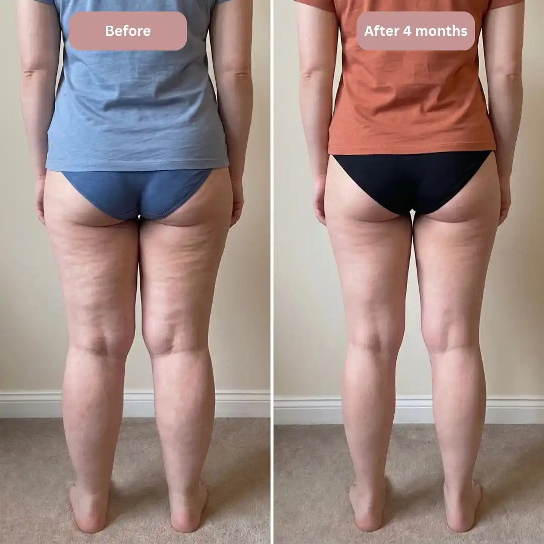 Cellumove 3D legging - say goodbye to lipedema pain and swelling naturally
