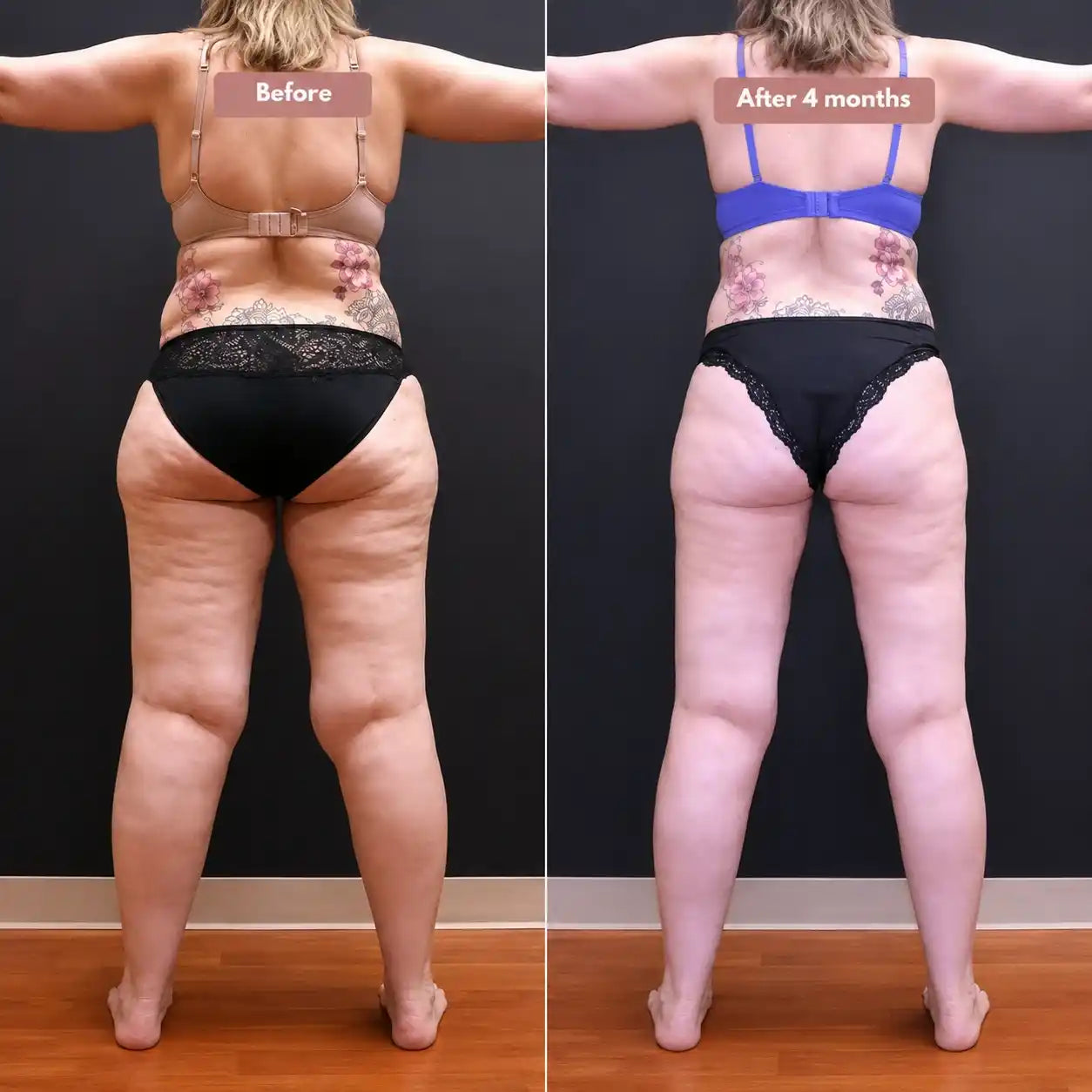 Cellumove 3D legging - say goodbye to lipedema pain and swelling naturally