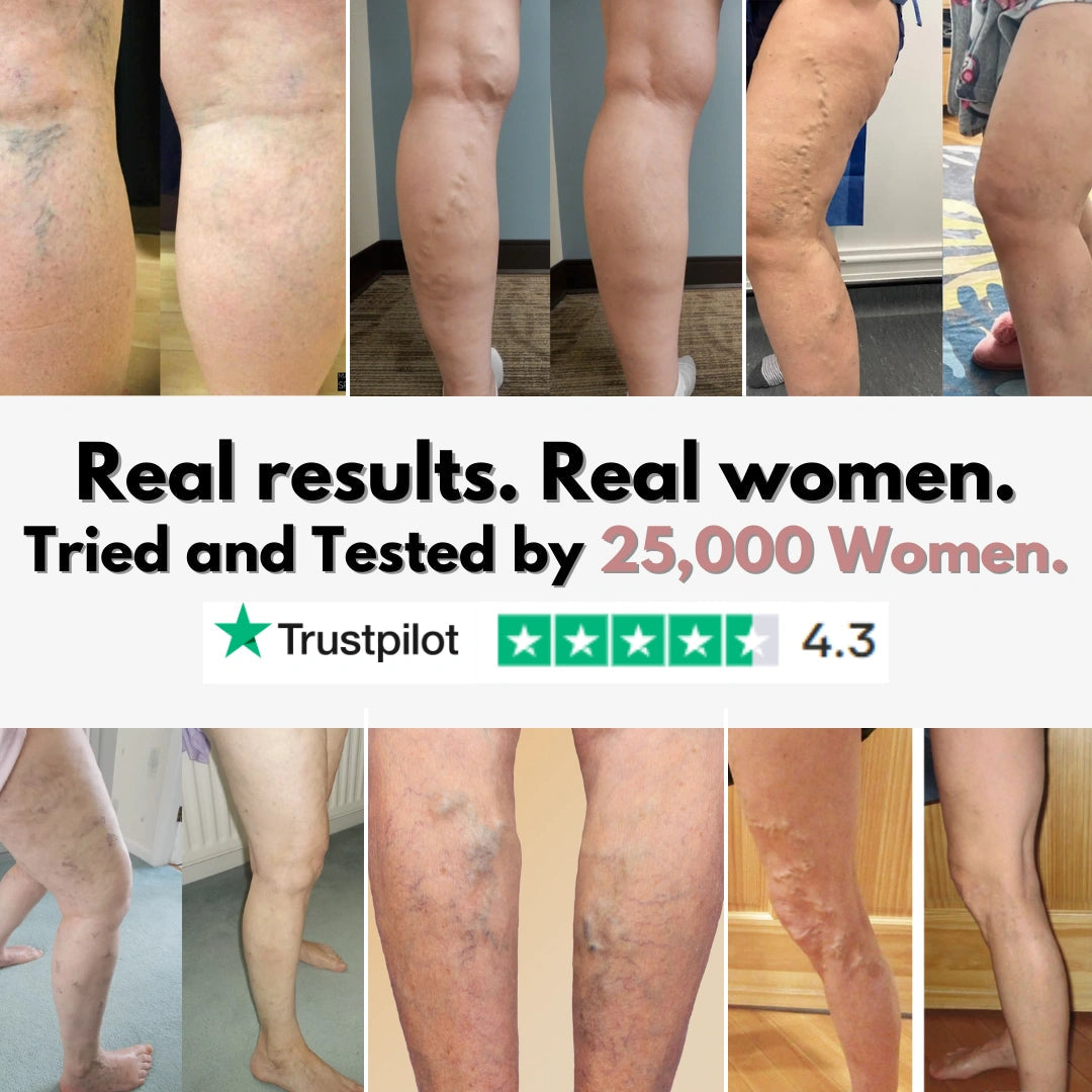 From Spider Vein & heavy legs to visible relief for healthcare workers in 14 days Cellumove