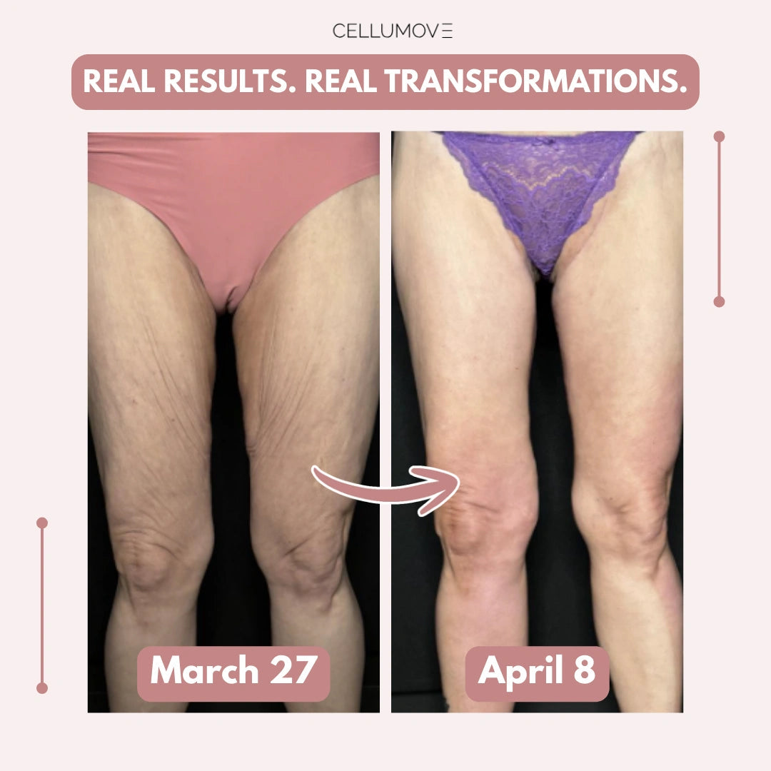 Firmer, smoother legs in 14 days — for women tired of saggy skin holding them back Cellumove