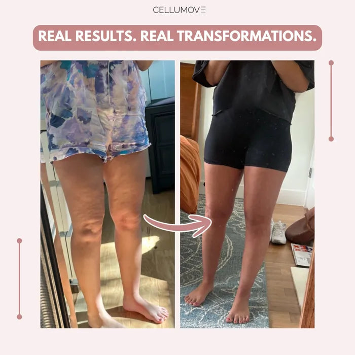 Cellumove 3D Legging – Say goodbye to lipoedema pain and swelling naturally Cellumove