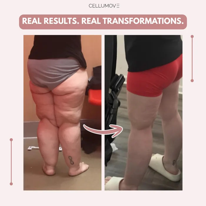 Cellumove 3D Legging – Say goodbye to lipoedema pain and swelling naturally Cellumove