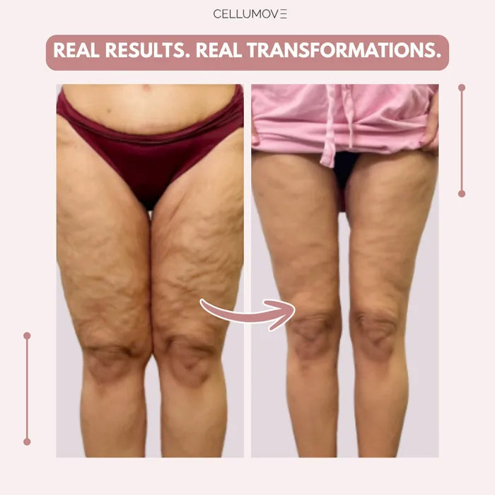 Cellumove 3D Legging – Say goodbye to lipoedema pain and swelling naturally Cellumove