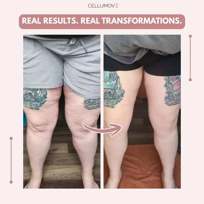 Cellumove 3D Legging – Say goodbye to lipoedema pain and swelling naturally Cellumove