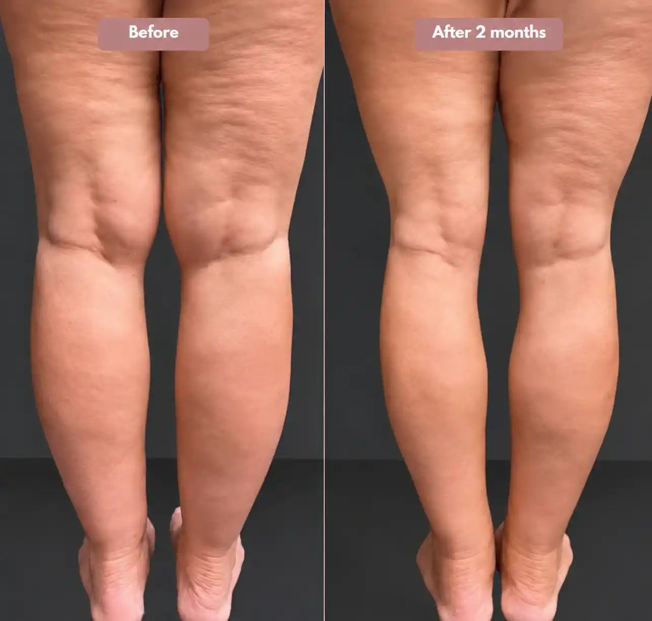Cellumove 3D legging - say goodbye to lipedema pain and swelling naturally