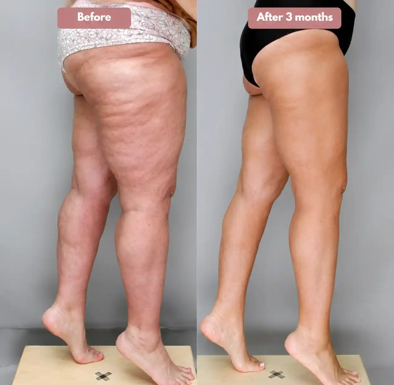 Cellumove 3D legging - say goodbye to lipedema pain and swelling naturally